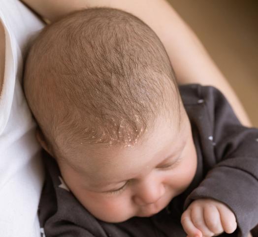 Baby Cradle Cap - Baby Child